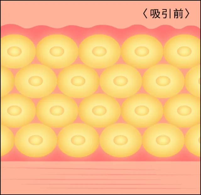 脂肪吸引などによる痩せ方