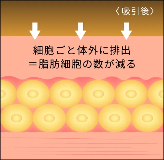 脂肪吸引などによる痩せ方