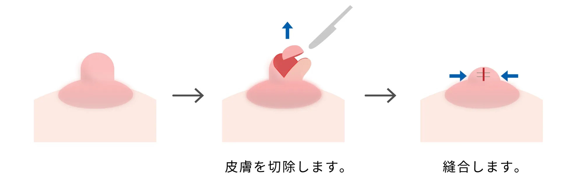 乳頭縮小