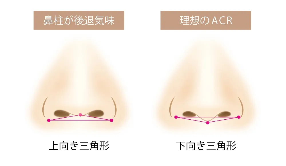 鼻翼挙上