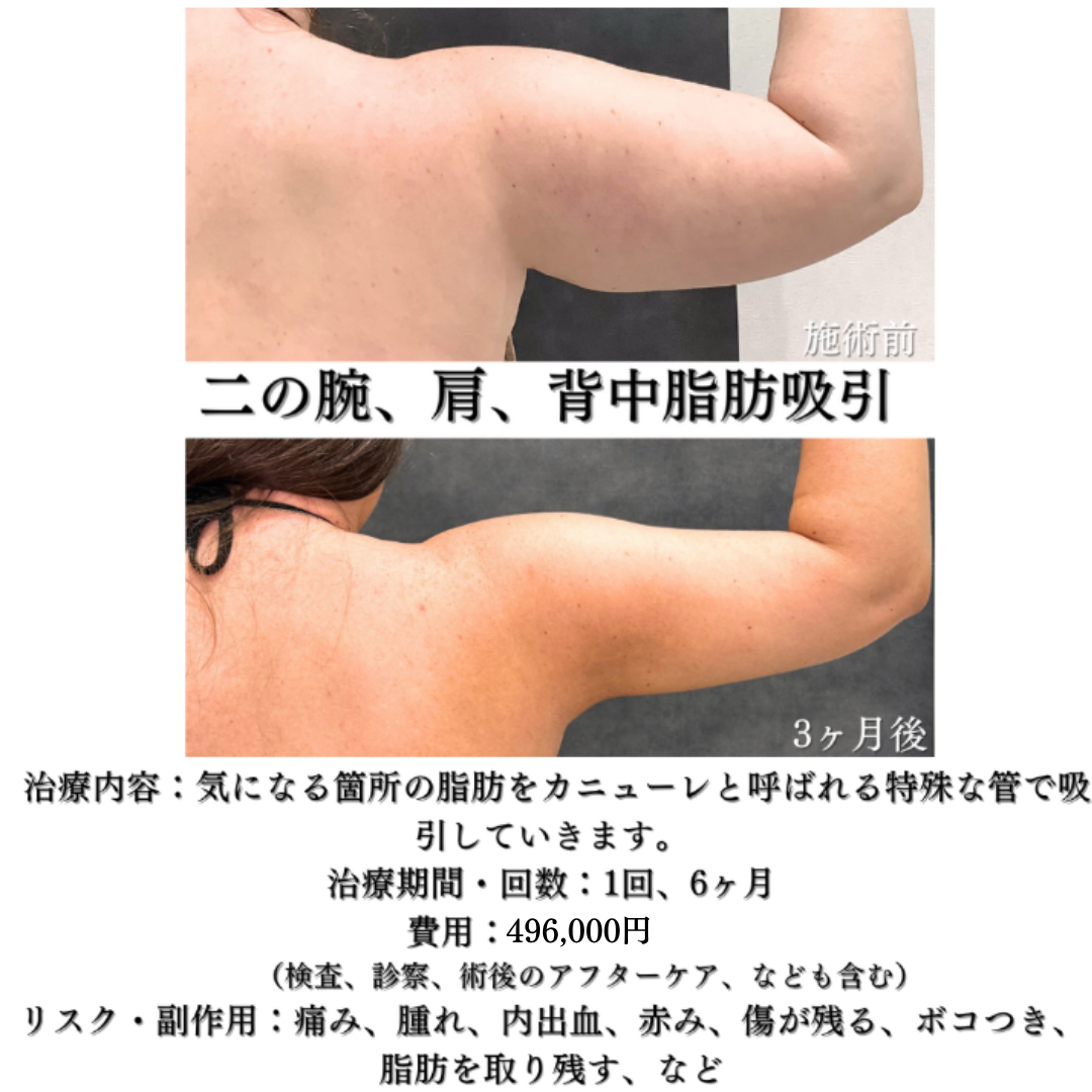 二の腕、肩、背中の脂肪吸引の症例です💁