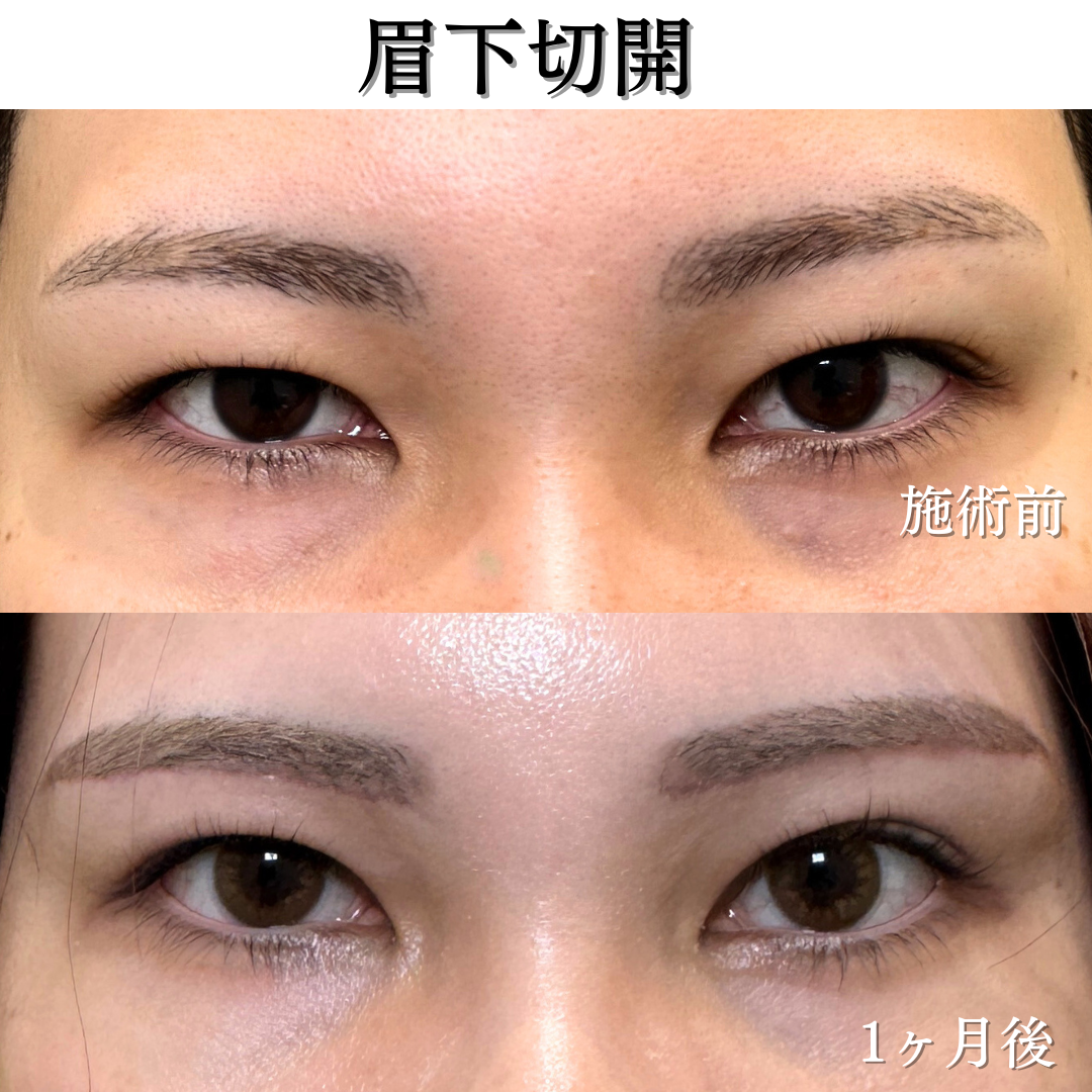 眉下切開の症例です💁♀️