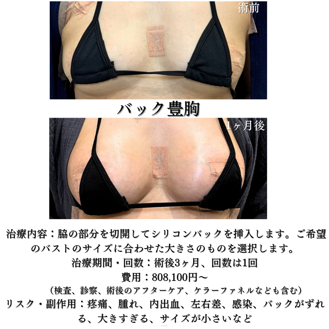 バック豊胸の症例です✨