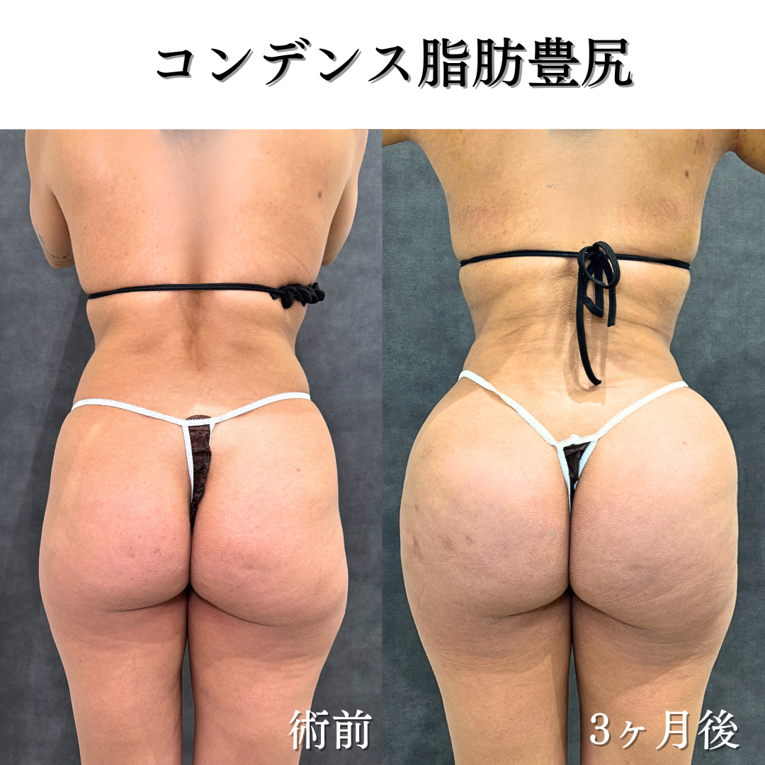 コンデンス脂肪豊尻（BBL）の症例です💡
