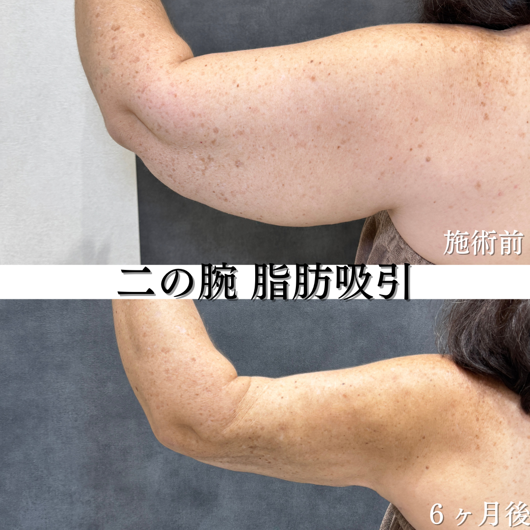 二の腕、肩、の脂肪吸引の症例です💡