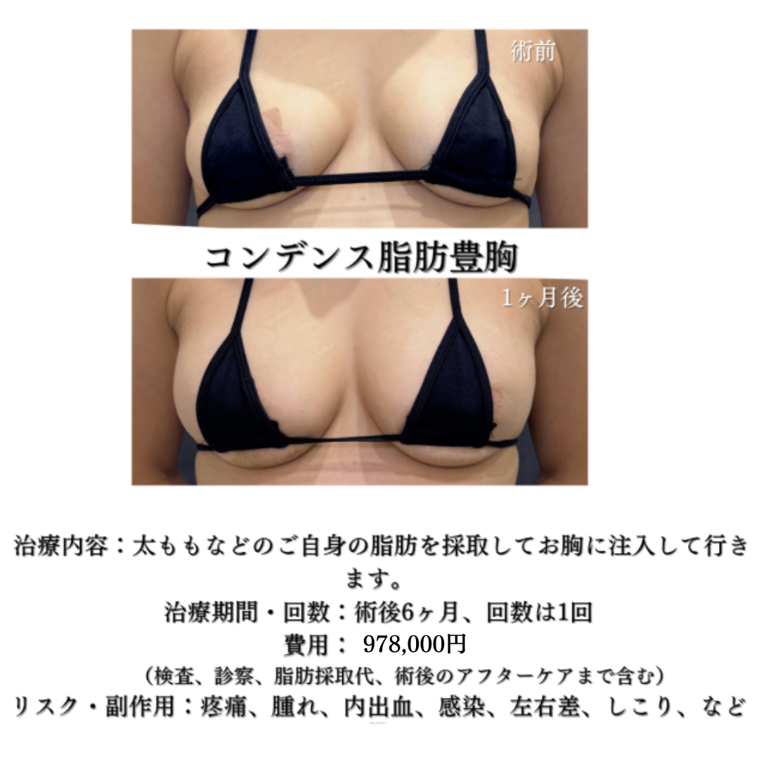 大人気！コンデンス脂肪豊胸の症例です💁‍♀️