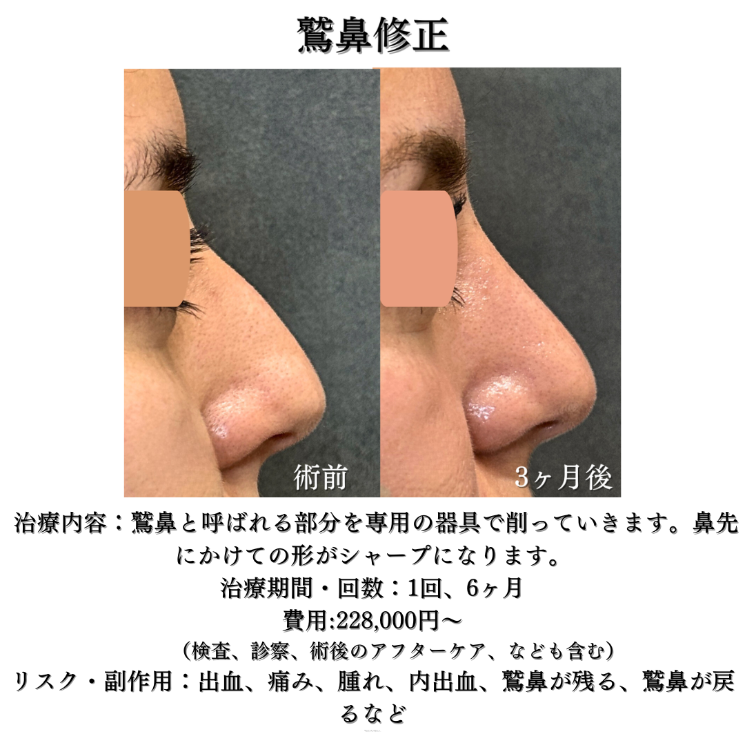 わし鼻修正の症例です💁