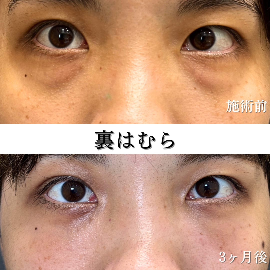裏はむらの症例です。