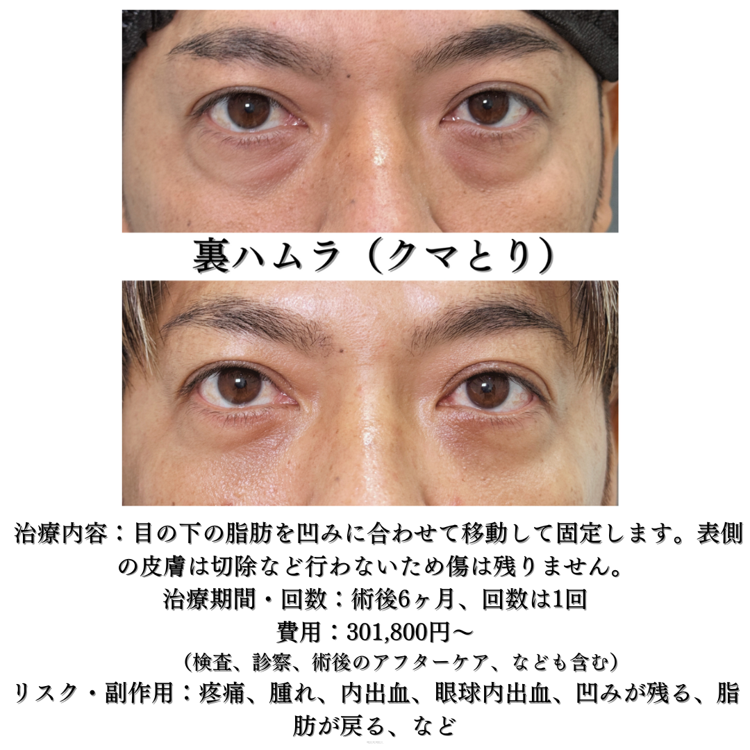 裏ハムラ１ヶ月後　男性の方