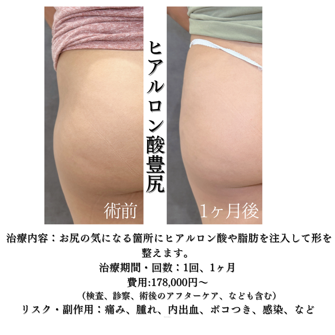 💎ヒアルロン酸豊尻の方の症例です💎