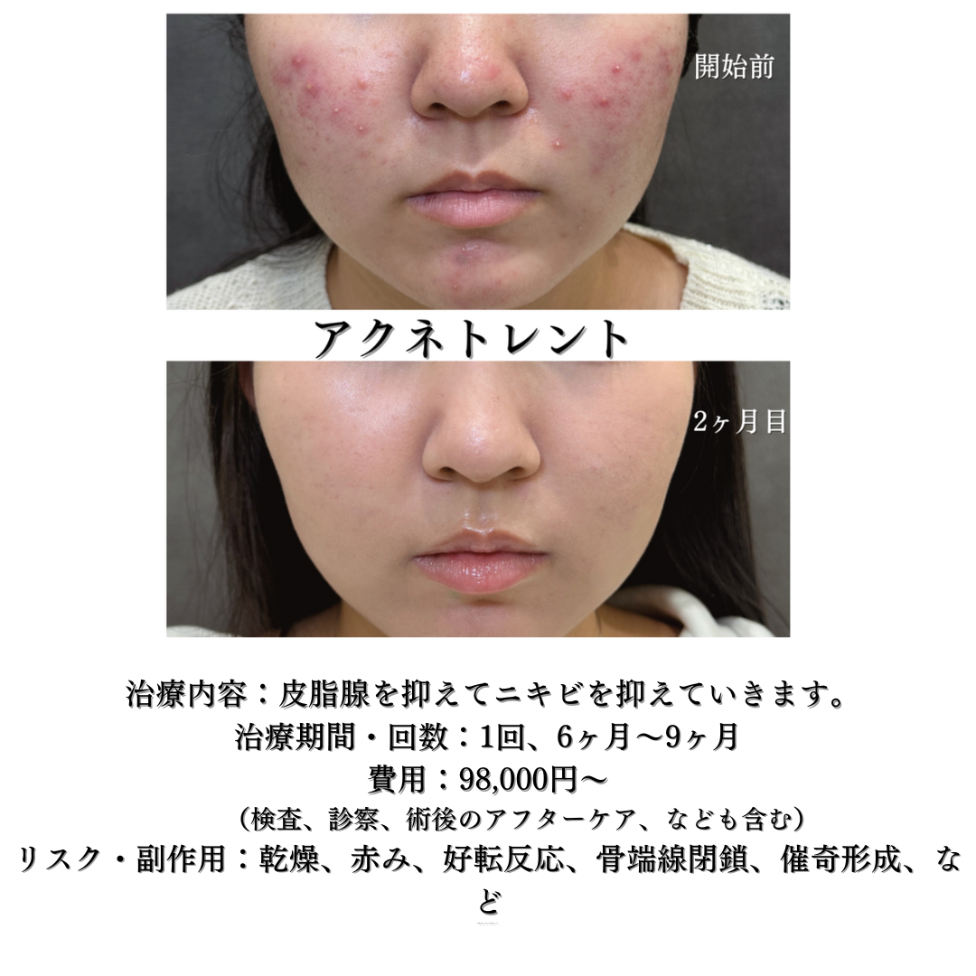 アクネトレントの症例です✨