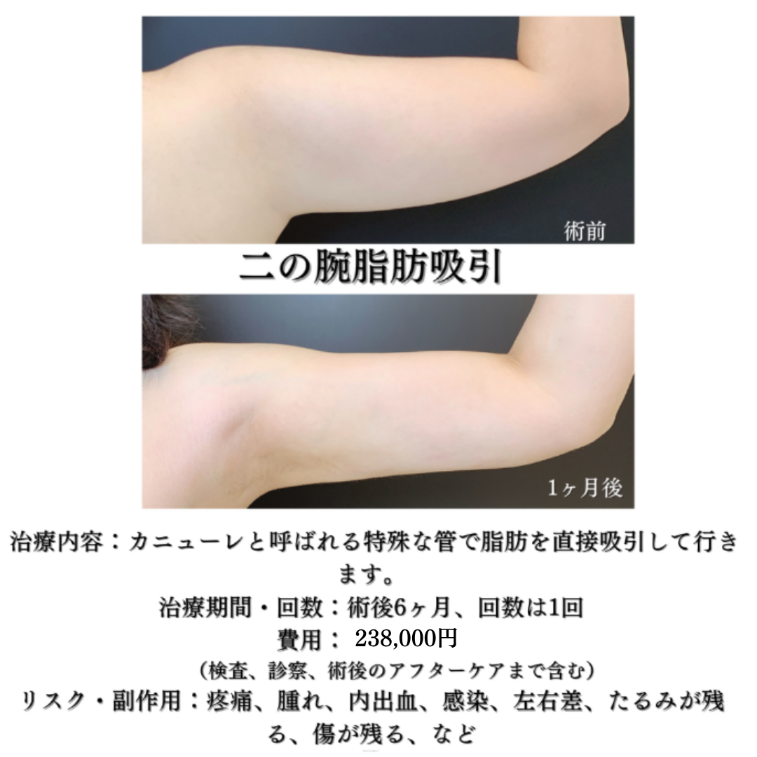 二の腕脂肪吸引の症例です💁‍♀️