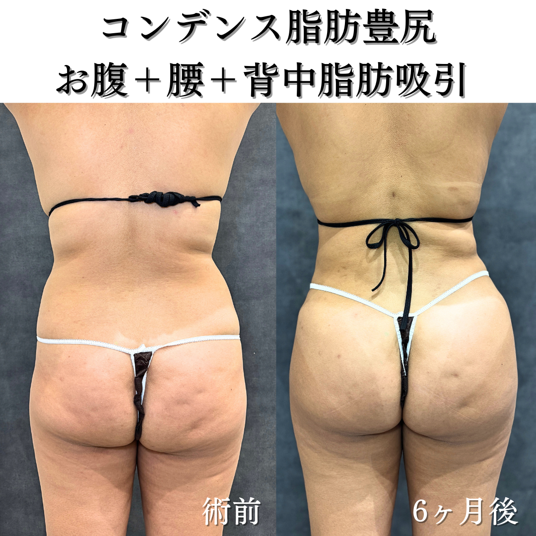 コンデンス脂肪豊尻、お腹+腰+背中脂肪吸引の症例です💁