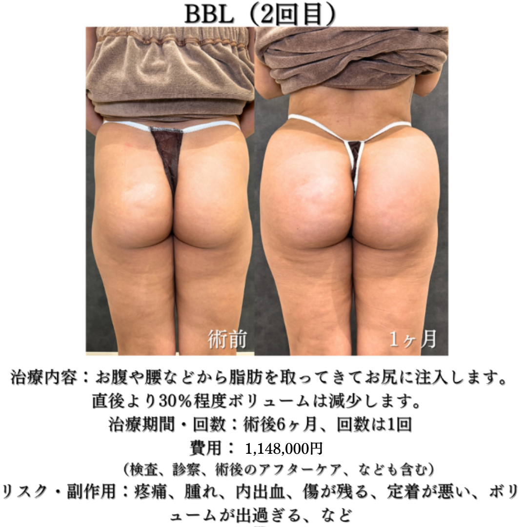 コンデンス脂肪豊尻（BBL）の症例です✨