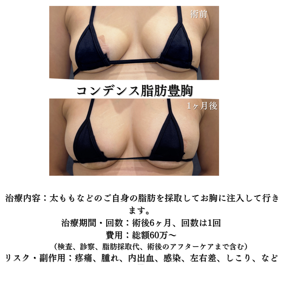大人気！コンデンス脂肪豊胸の症例です💁‍♀️