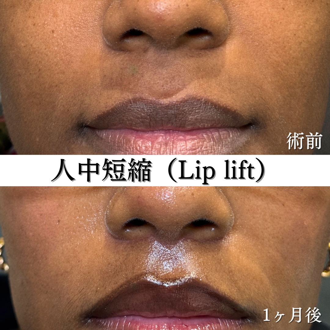 人中短縮1ヶ月です💁♀️
