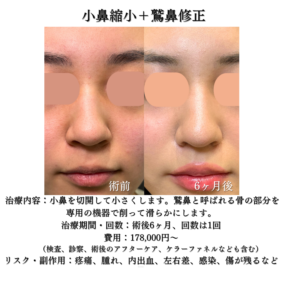 わし鼻修正+小鼻縮小の症例です💁‍♀️