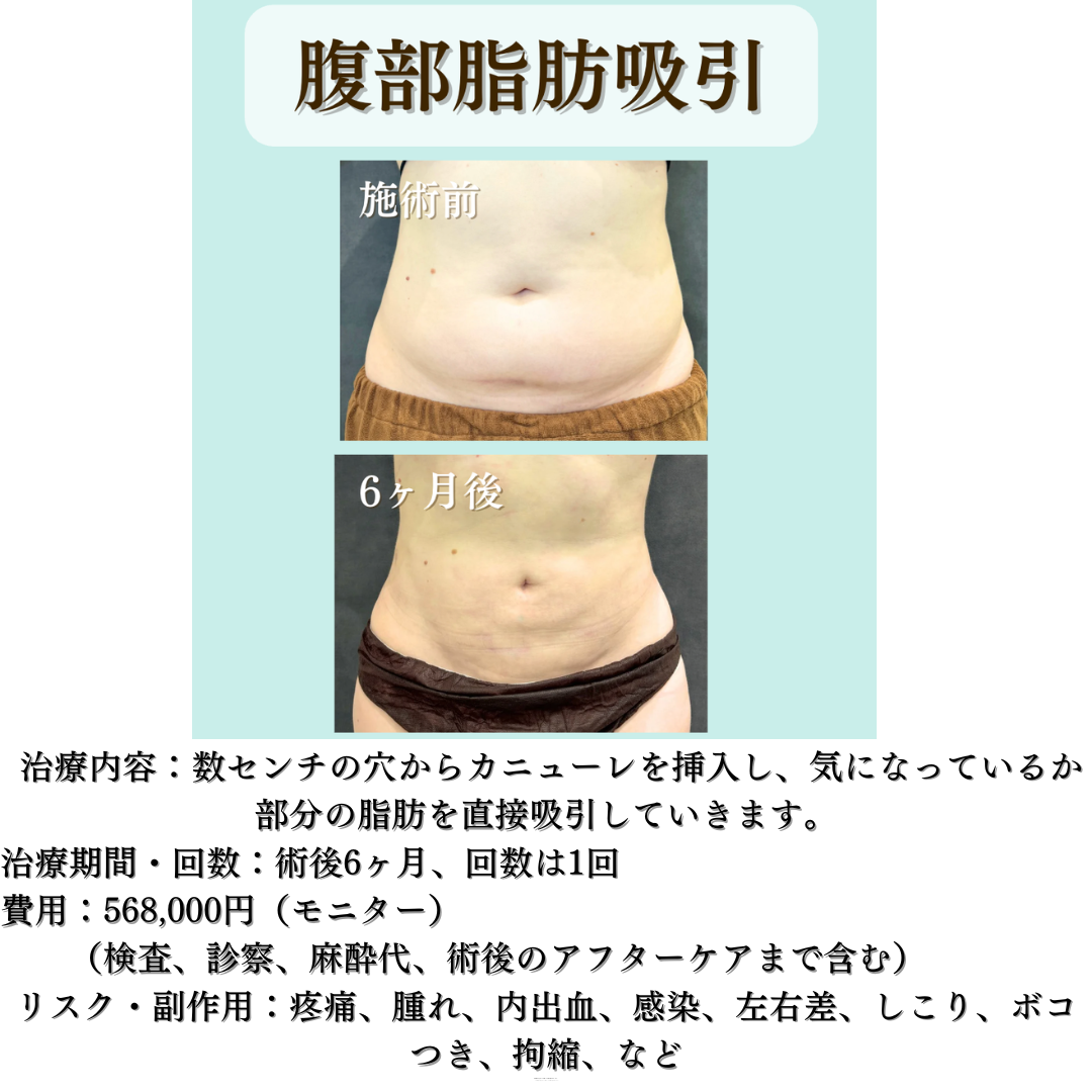 腹部脂肪吸引の症例です💁‍♀️