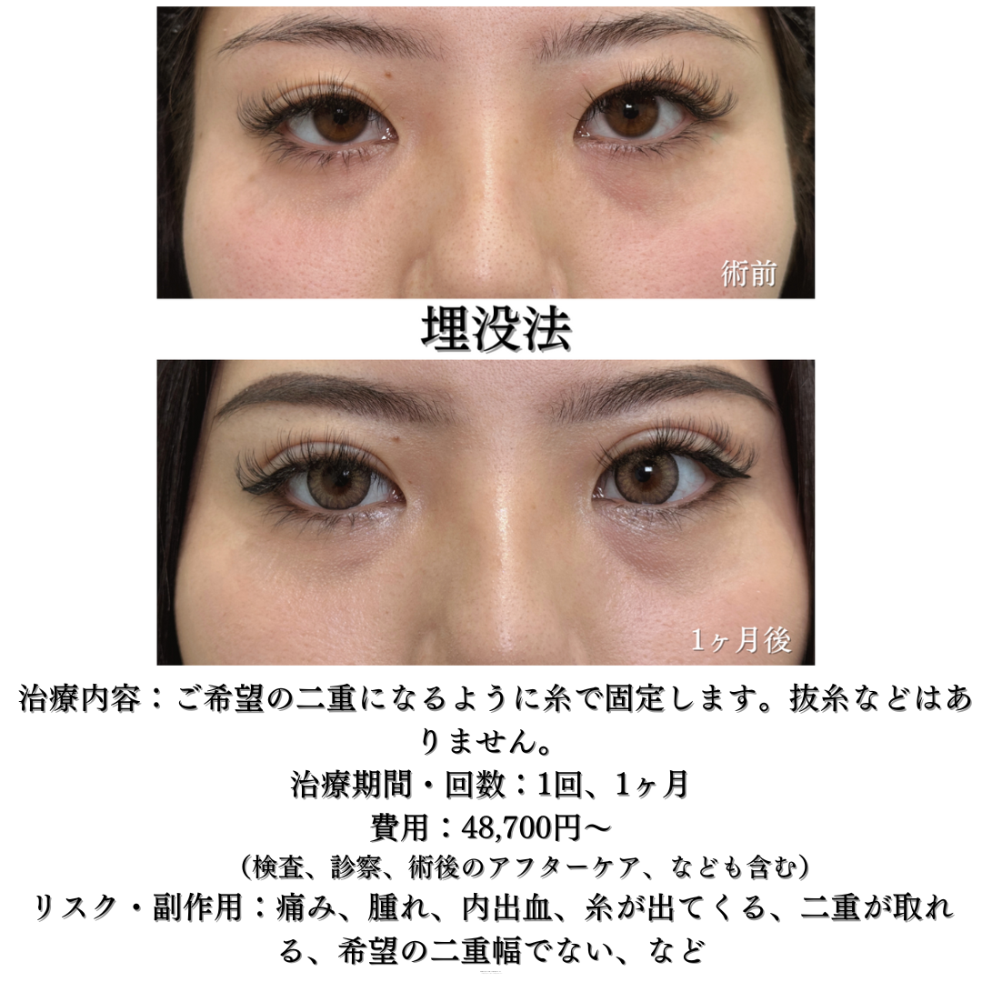 二重埋没法5点どめの症例です💁‍♀️