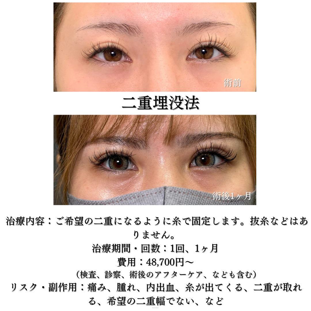 二重埋没法の症例です👁️