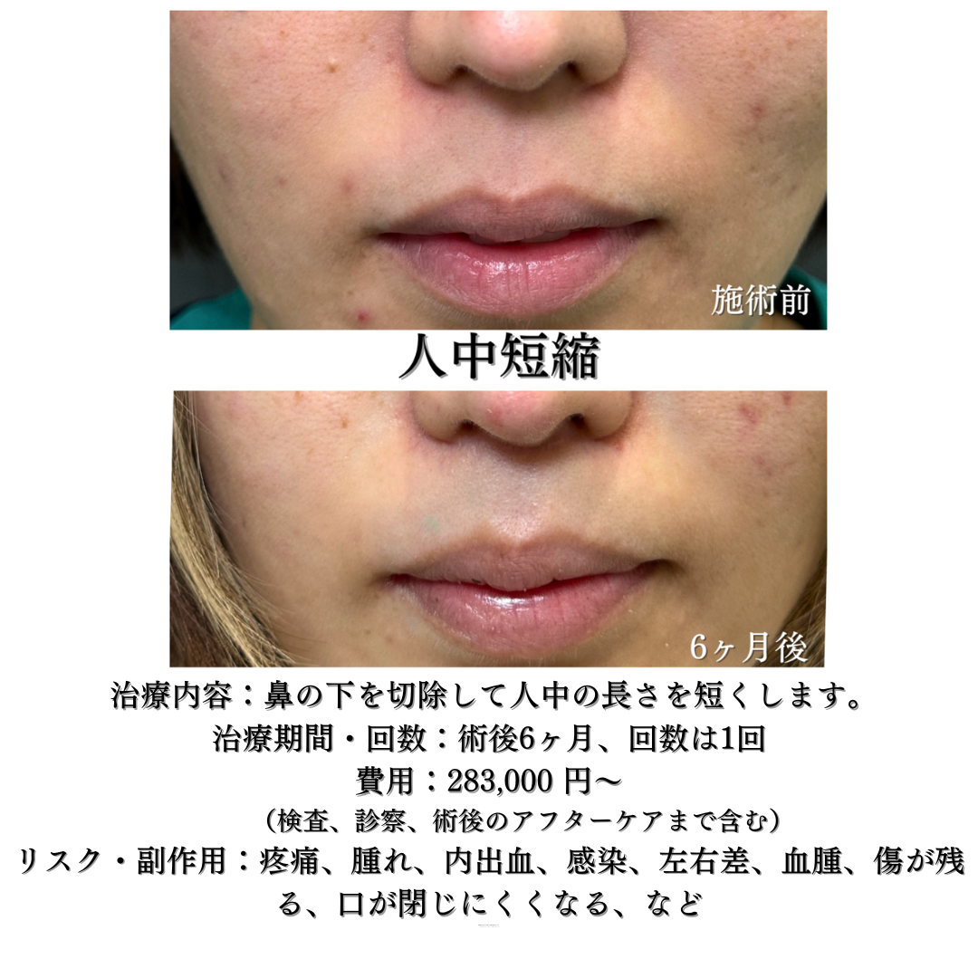 人中短縮の症例です💁