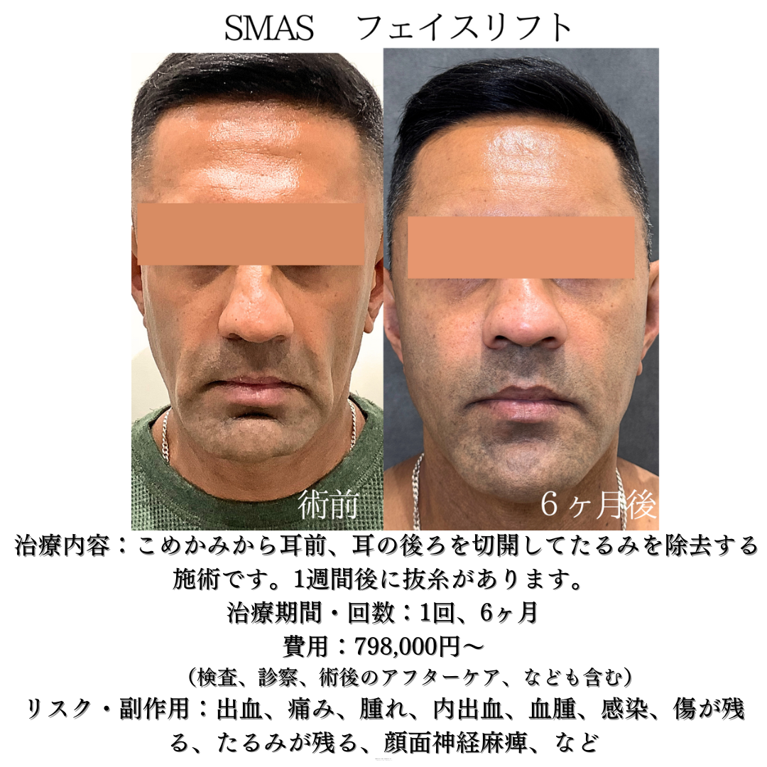 フェイスリフトの6ヶ月症例です👑