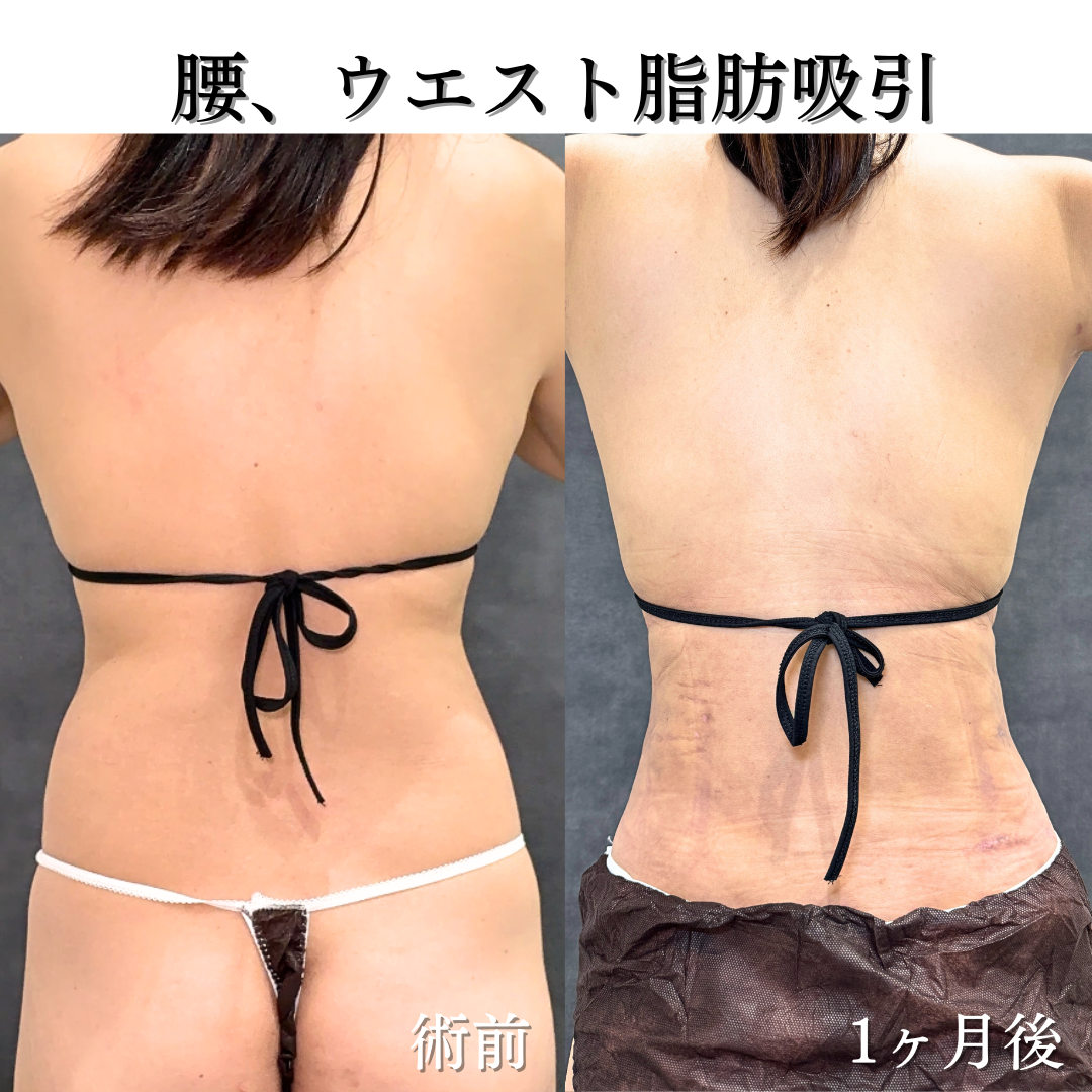 腰+ウエストの脂肪吸引の症例です💁♀️