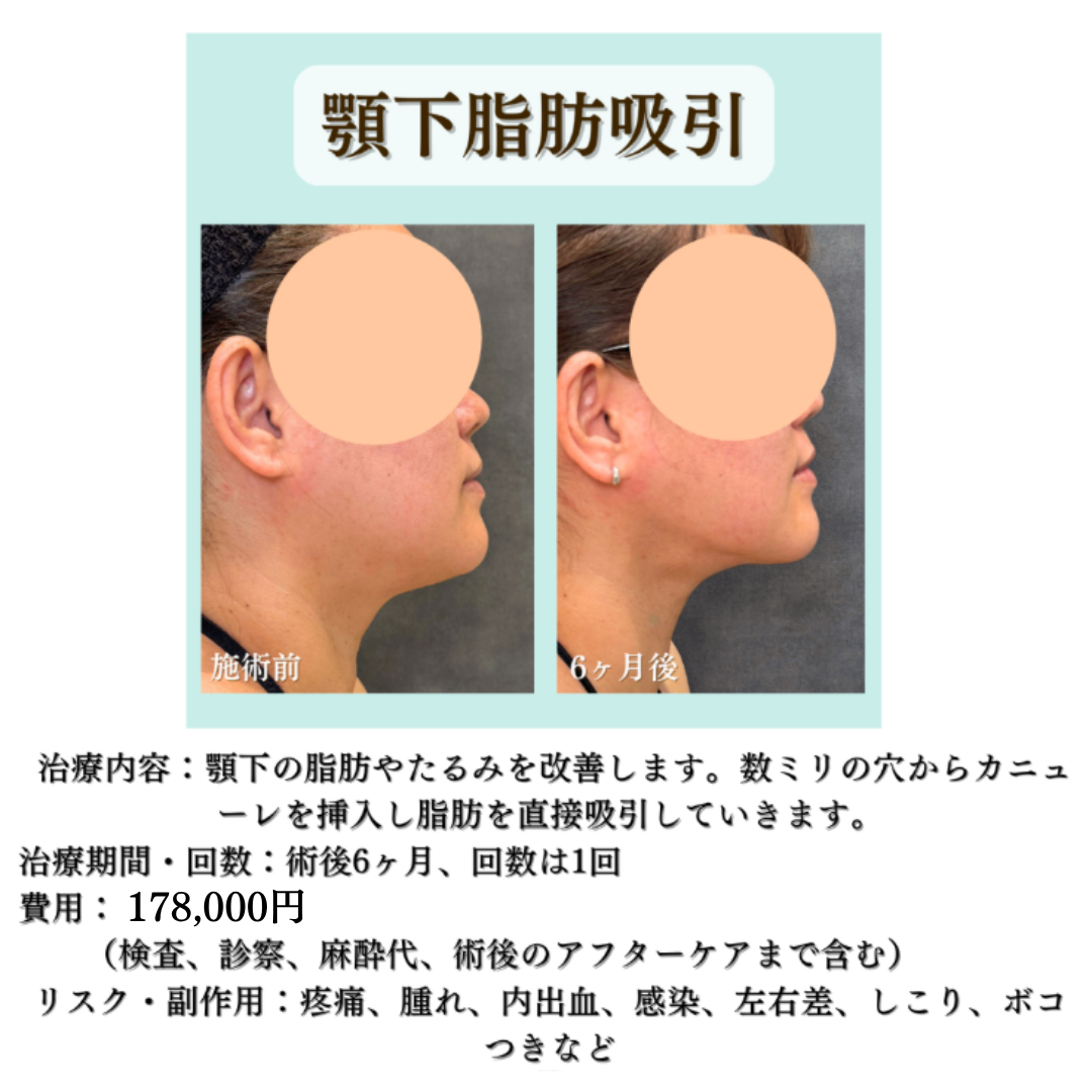 顎下脂肪吸引の症例になります💁