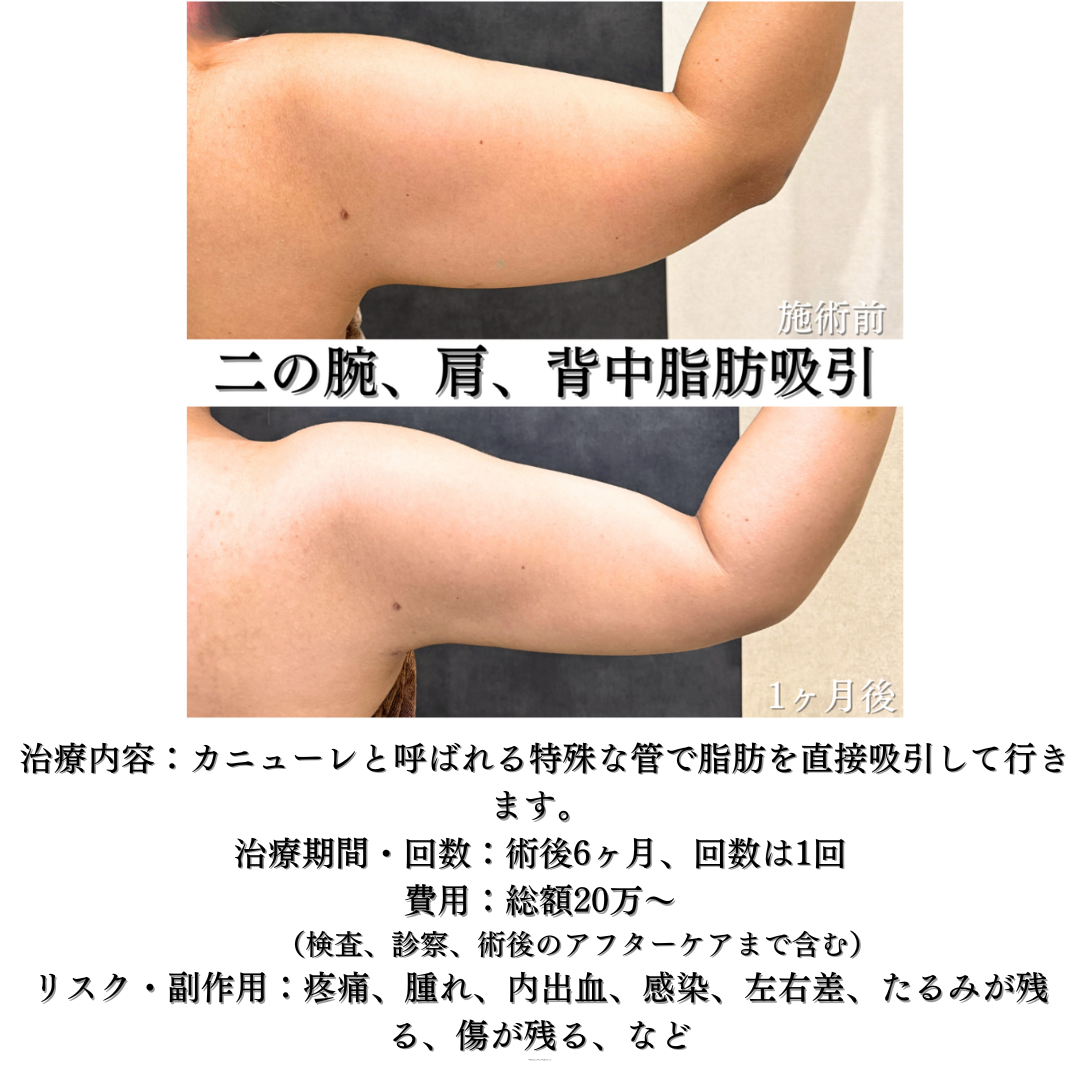 二の腕、肩、背中の脂肪吸引の症例です💁‍♀️