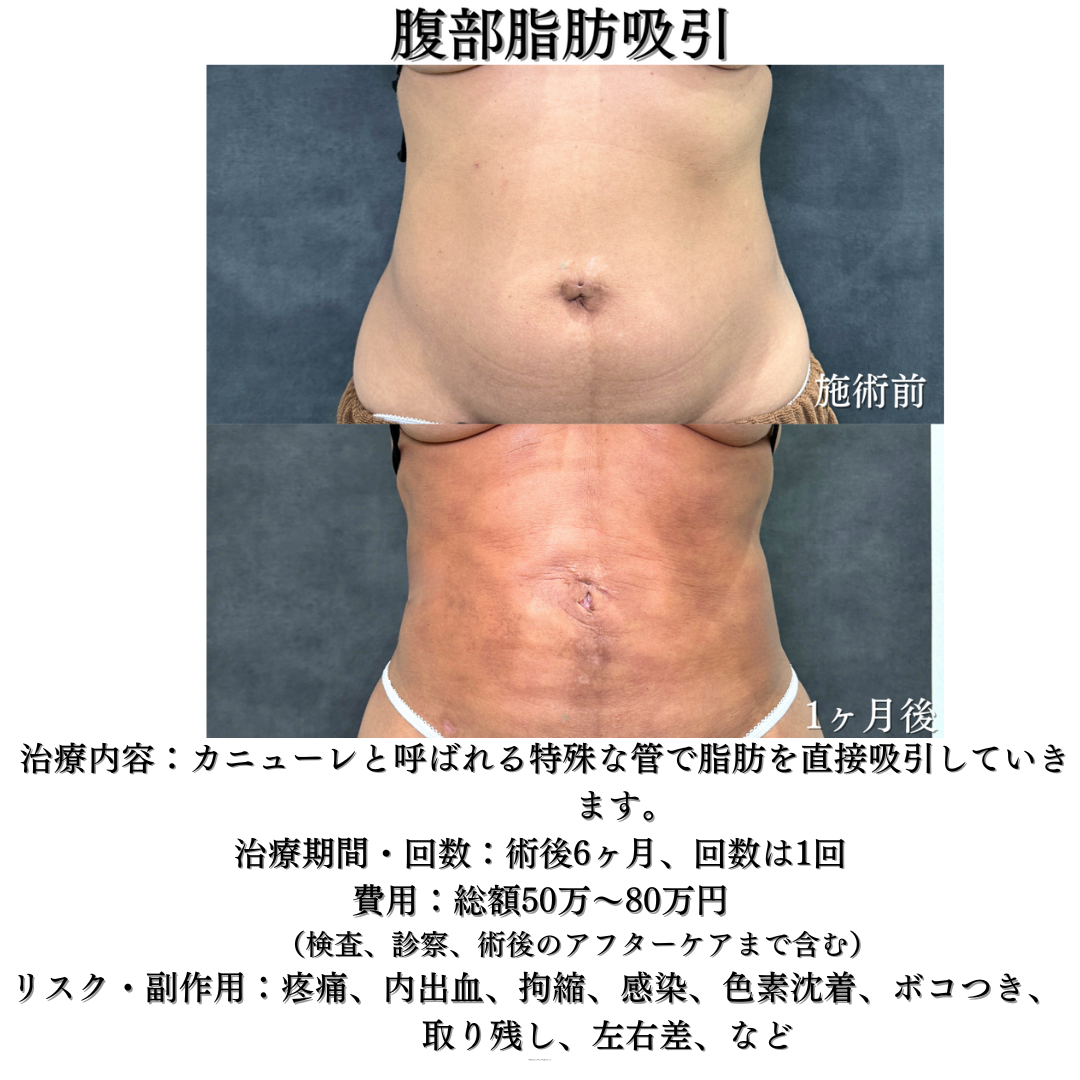 腹部脂肪吸引の症例です💁♀️