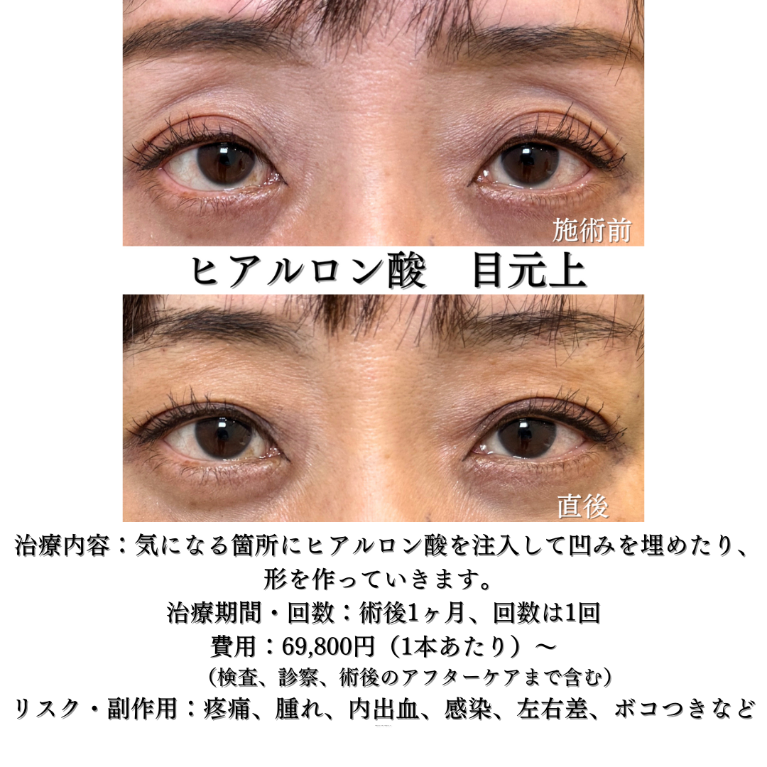 目の上のヒアルロン酸の症例です💁