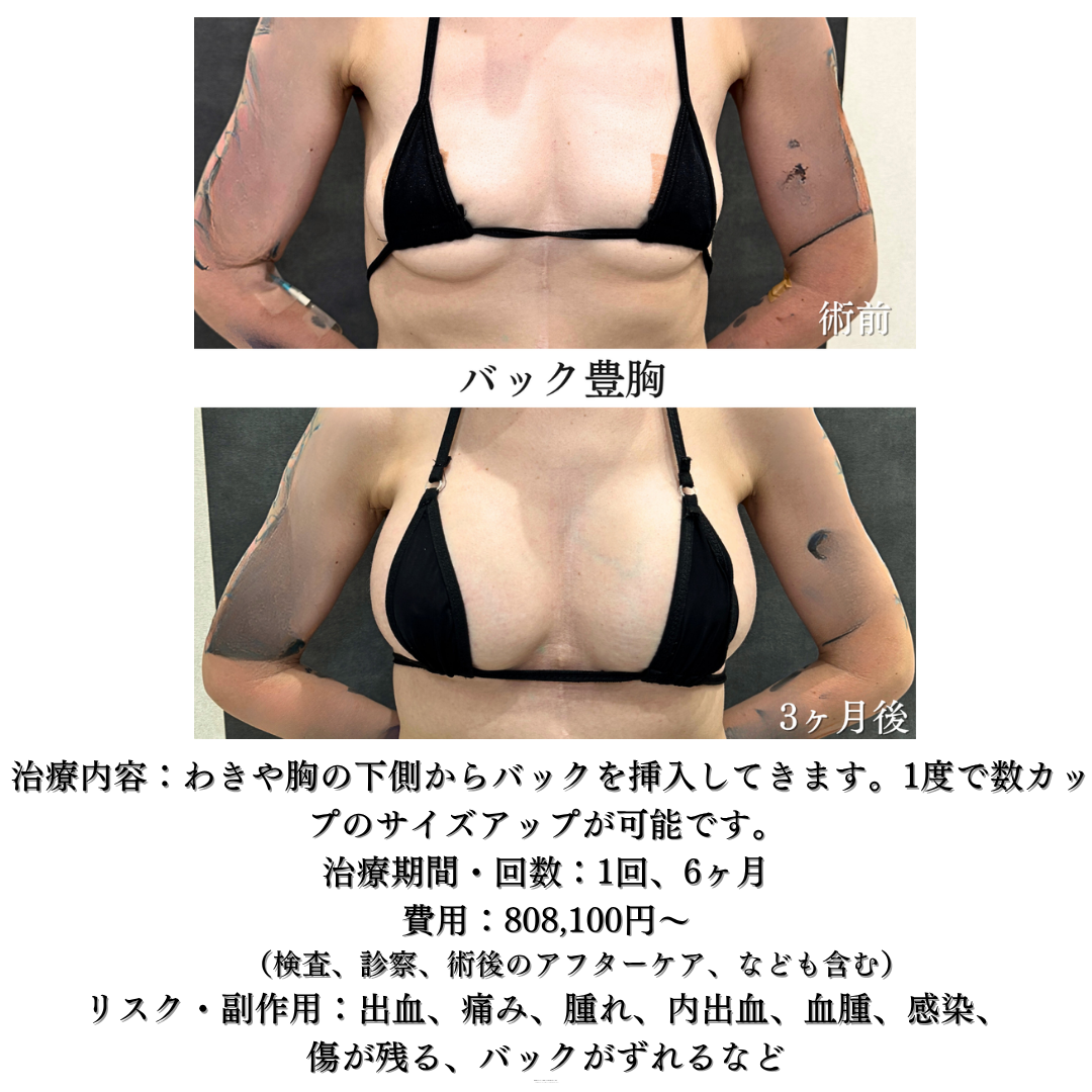 バック豊胸の方です✨