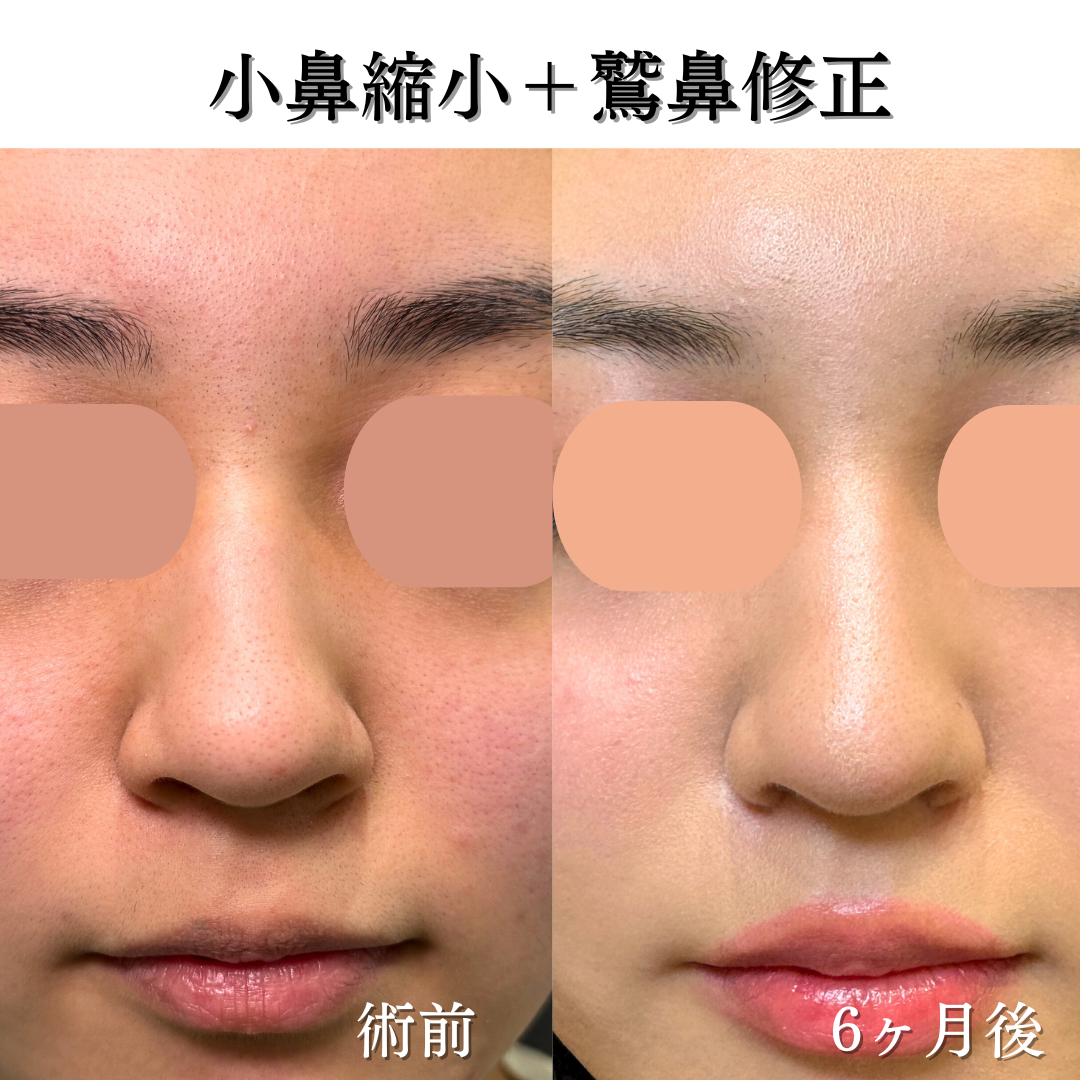 わし鼻修正+小鼻縮小の症例です💁♀️