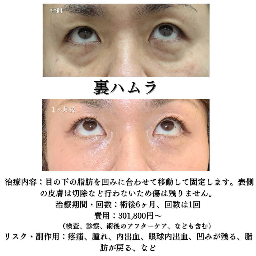 くまとり！裏ハムラ法👁️