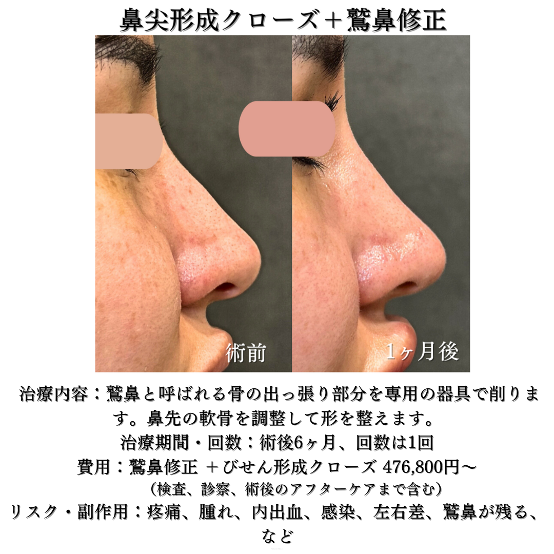 鼻尖形成クローズ＋耳介軟骨移植＋鷲鼻修正