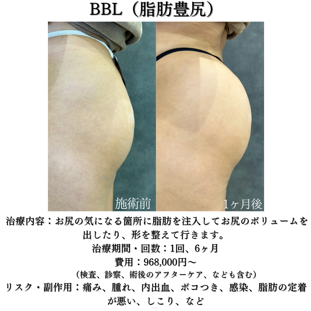 コンデンス脂肪豊尻（BBL）の症例です💁‍♀️