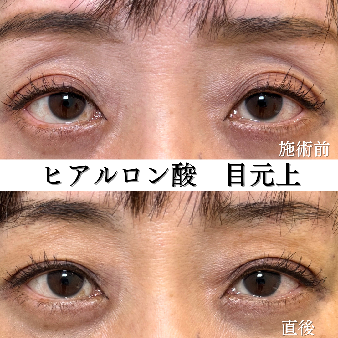 目の上のヒアルロン酸の症例です💁