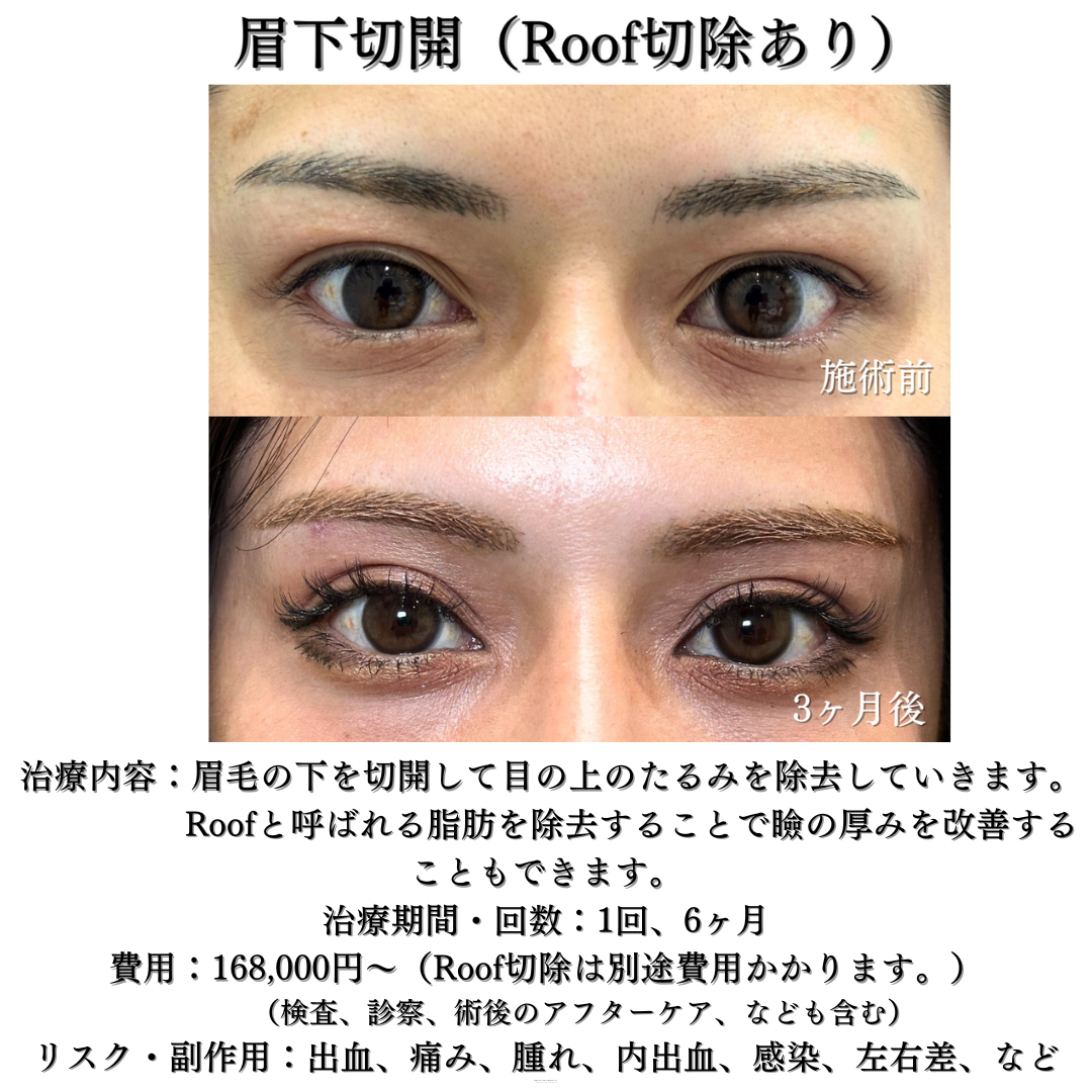 眉下切開の症例です💁♀️