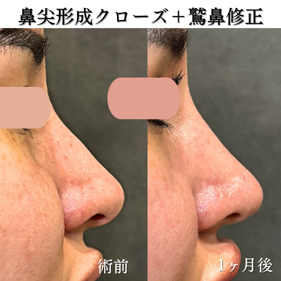 鼻尖形成クローズ＋耳介軟骨移植＋鷲鼻修正
