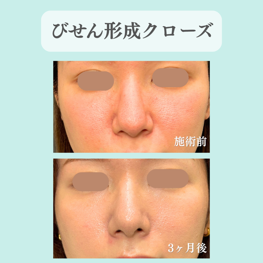鼻尖形成クローズ法の症例です💁