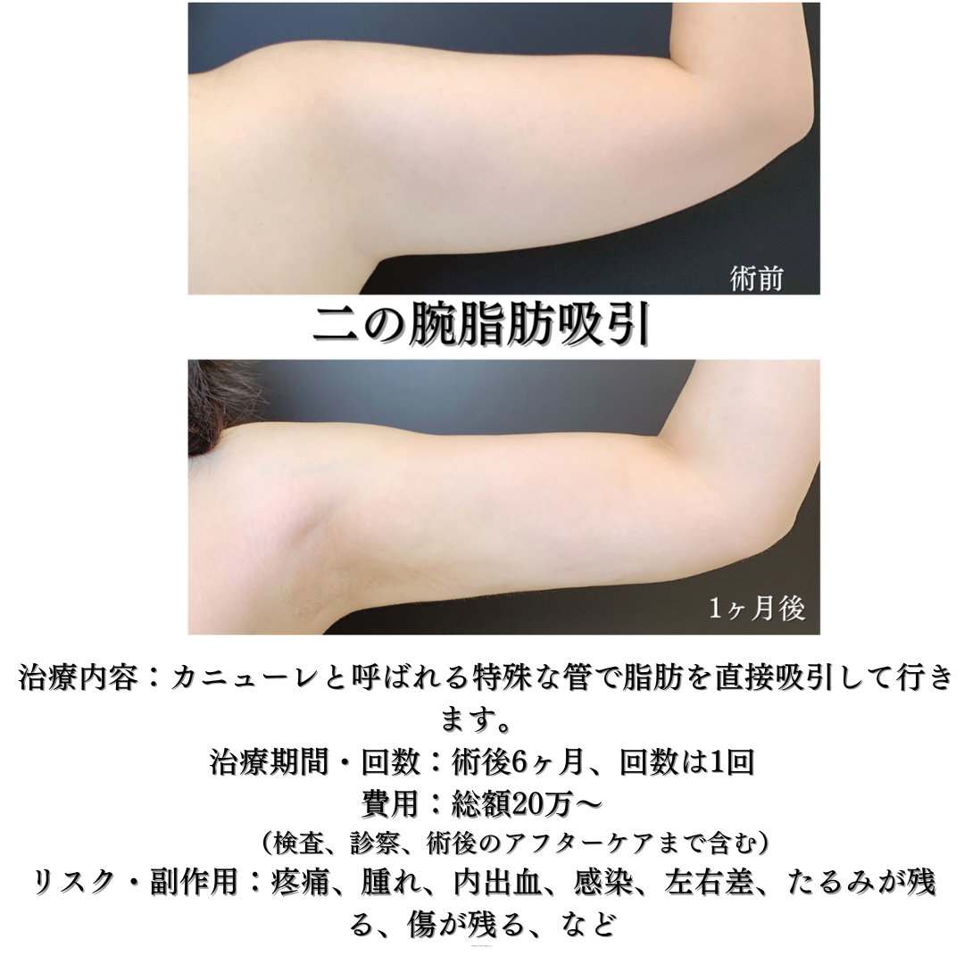 二の腕脂肪吸引の症例です💁‍♀️