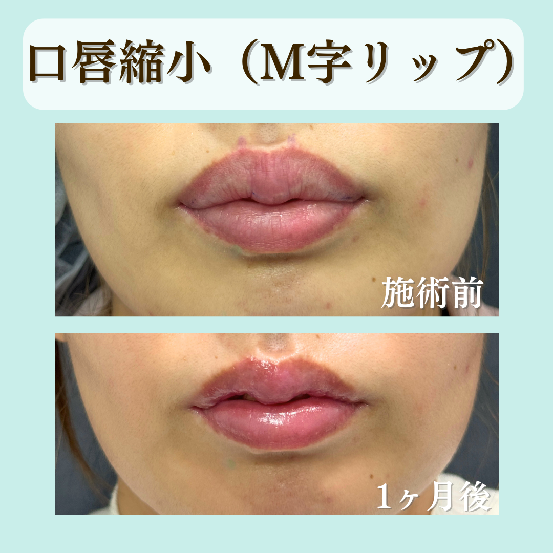 口唇縮小（M字リップ形成）の症例です💁
