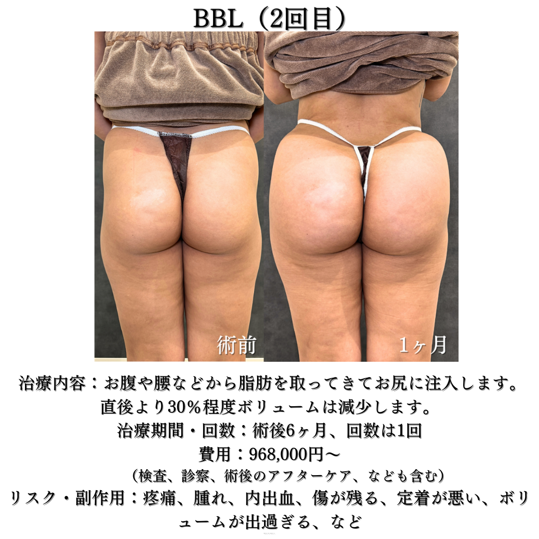 コンデンス脂肪豊尻（BBL）の症例です✨