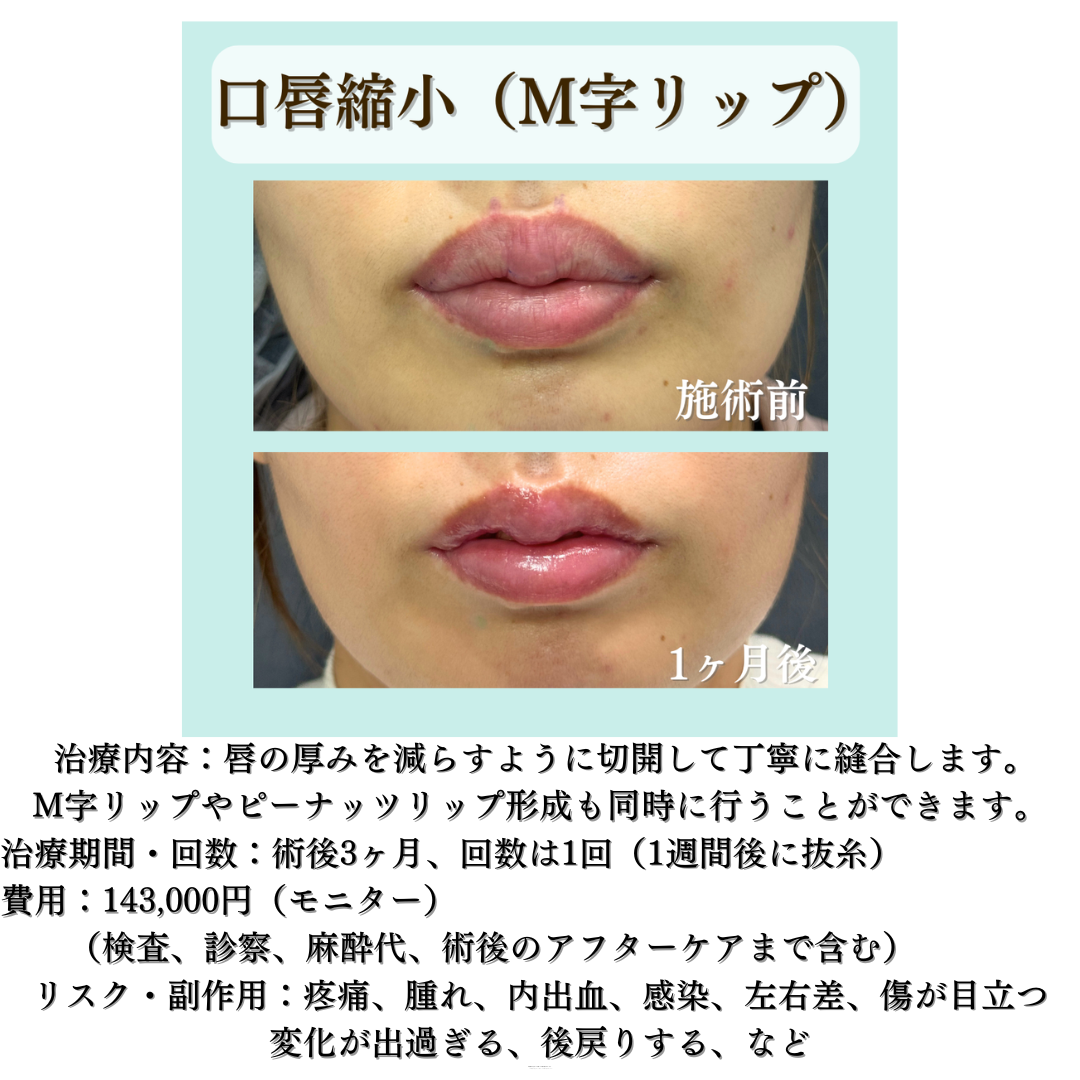 口唇縮小（M字リップ形成）の症例です💁