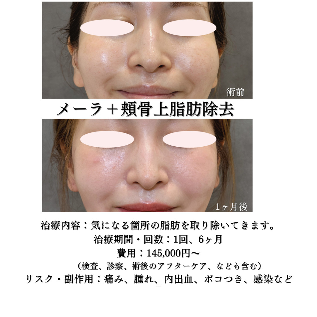 メーラーファット除去と頬骨上脂肪吸引注射