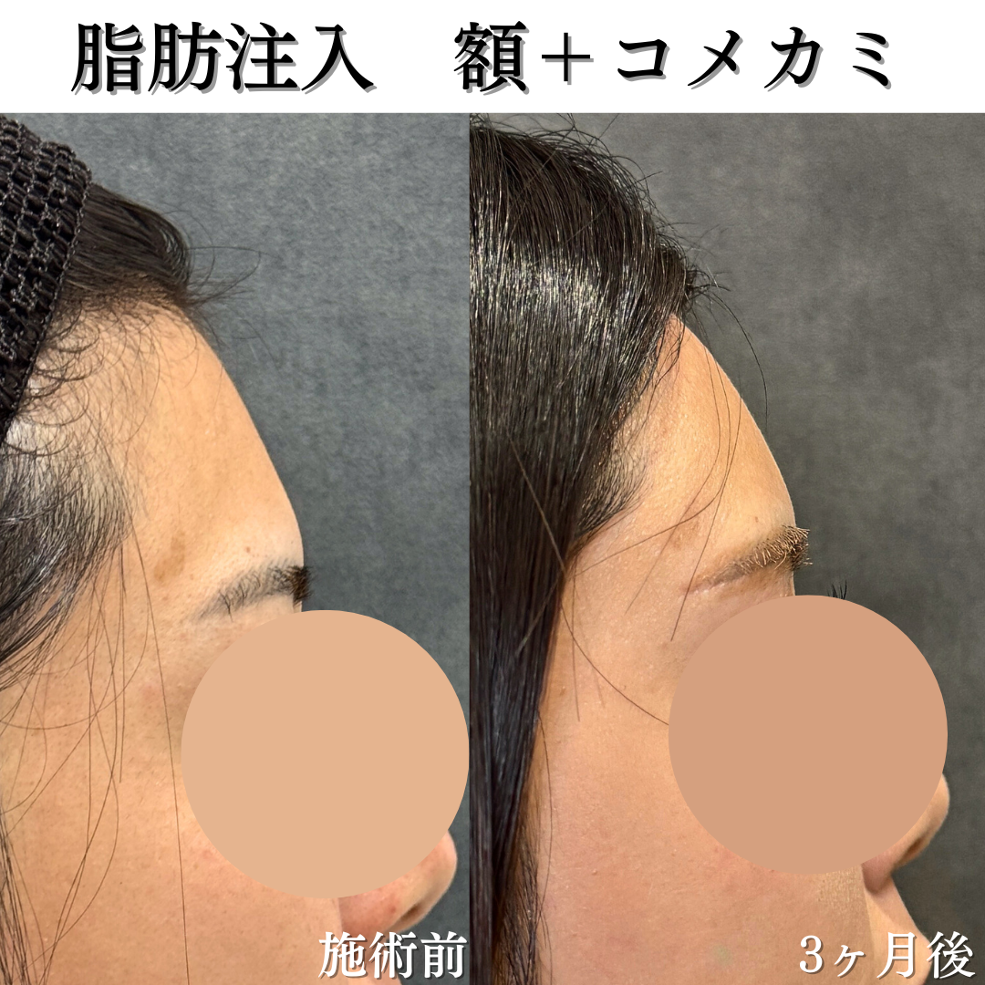 額、こめかみ、法令線の脂肪注入の症例です💁