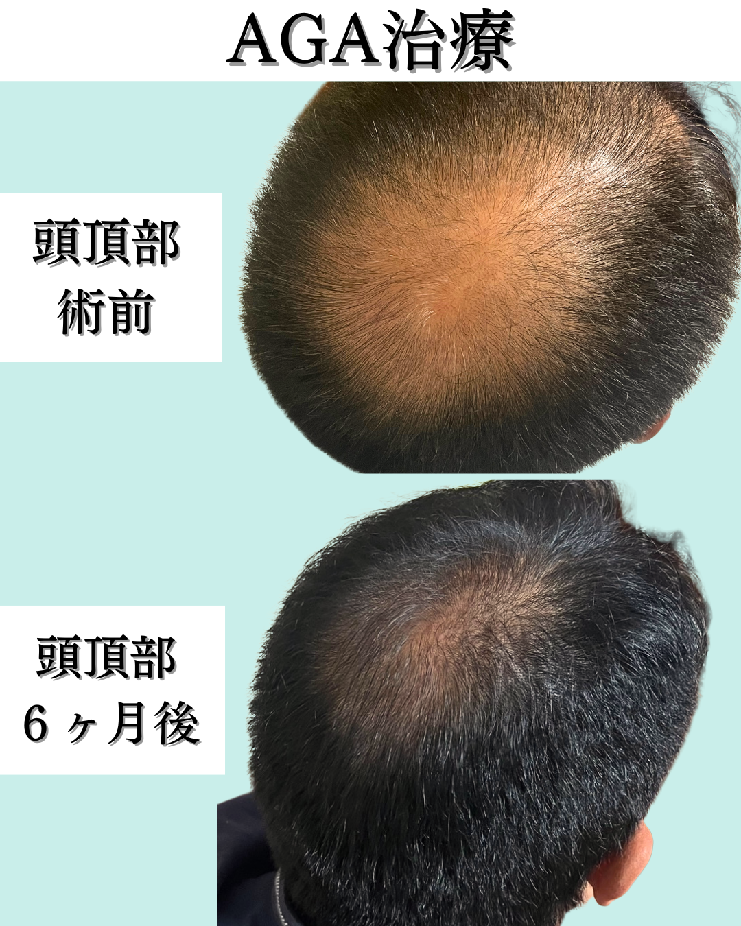 AGA治療（2剤併用）