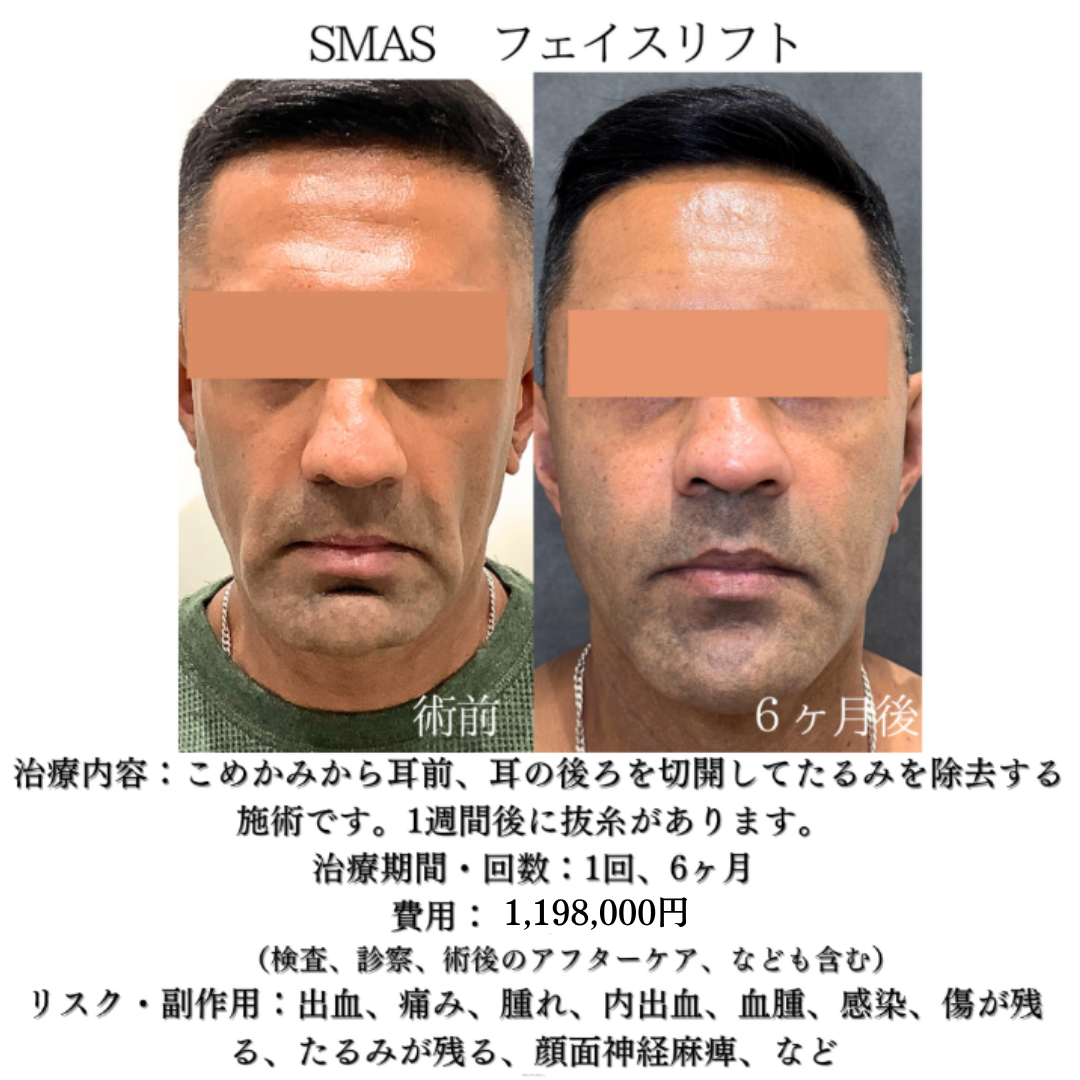 フェイスリフトの6ヶ月症例です👑