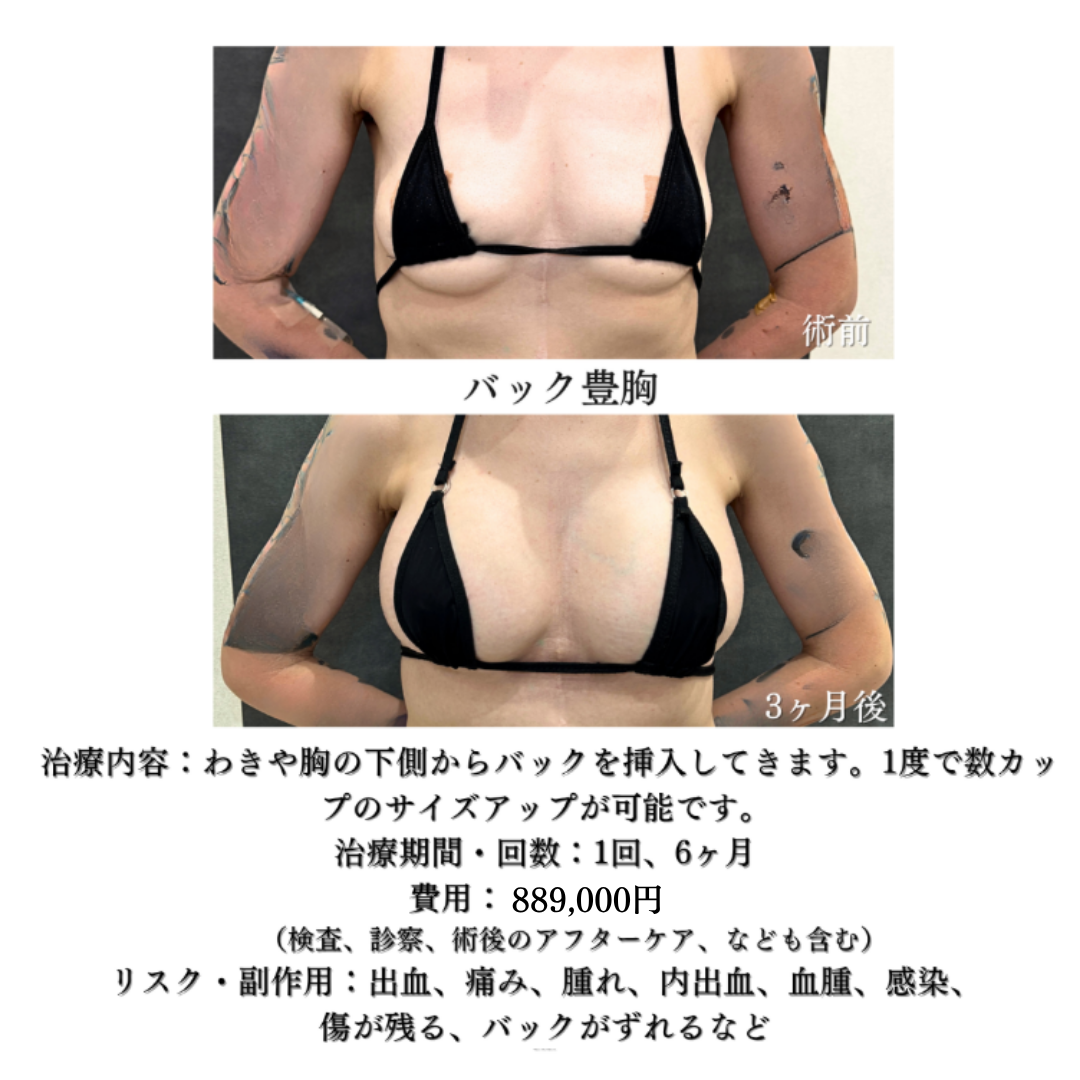 バック豊胸の方です✨