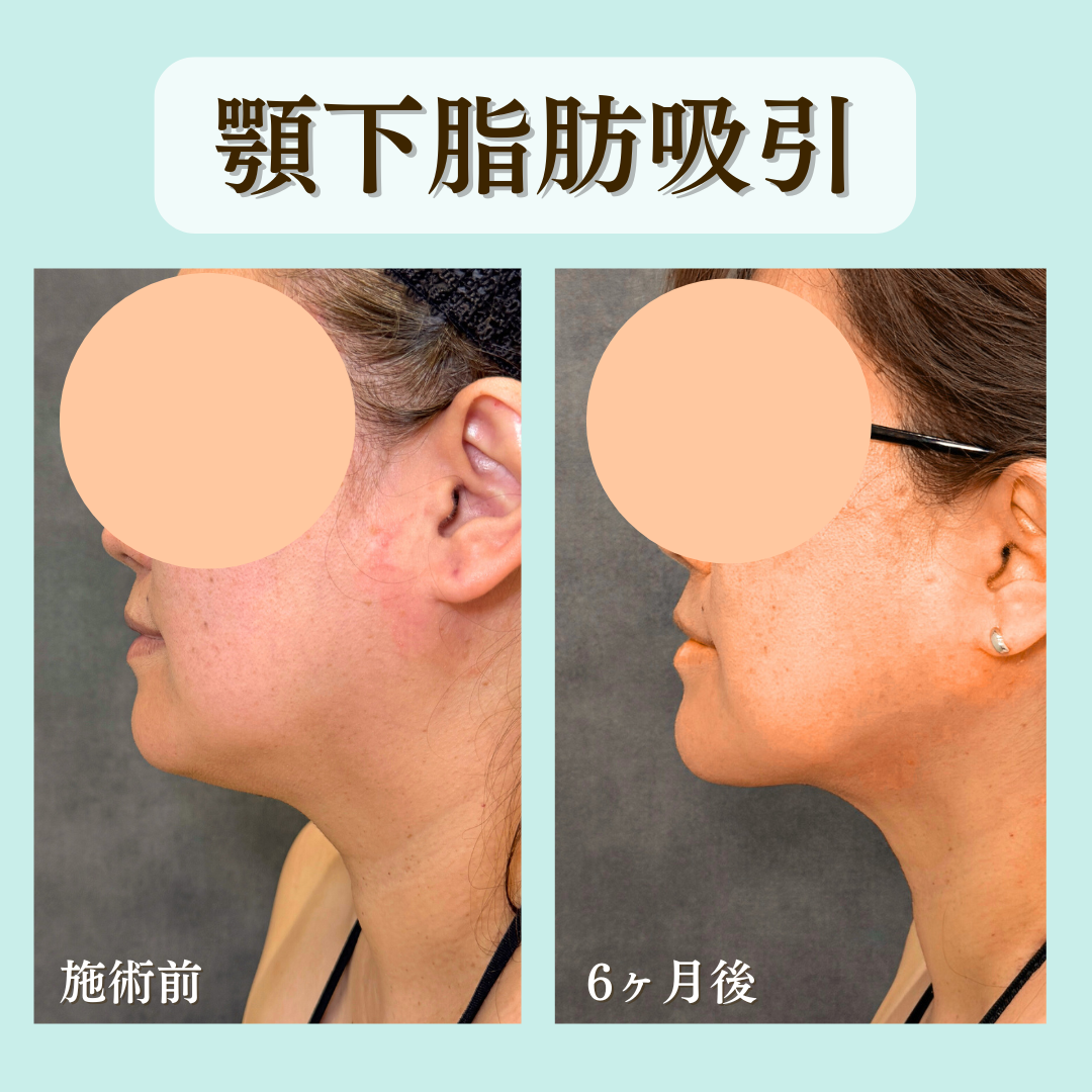 顎下脂肪吸引の症例になります💁